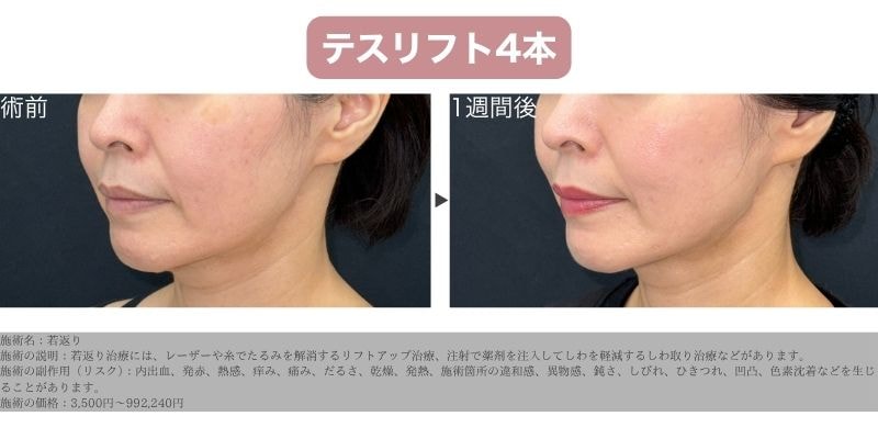 若返り症例：40代女性